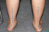 Một số kiến thức về bàn chân bẹt