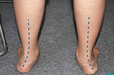 Một số kiến thức về bàn chân bẹt