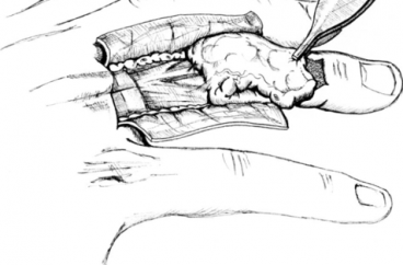 Anatomic Basis of Dorsal Finger Skin Cover