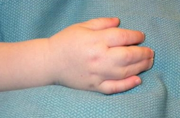 Đánh giá kết quả điều trị tật dính ngón bẩm sinh ở trẻ em