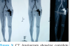 A Case Report: An Acute Thrombus in the Femoral Artery following Total Hip Arthroplasty