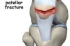 Current Treatment Strategies for Patella Fractures