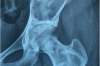 Điều trị phẫu thuật loạn sản sợi ở xương chi dưới