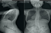 Surgical treatment of dropped head syndrome secondary to fascioscapulohumeral muscle dystrophy: a case report