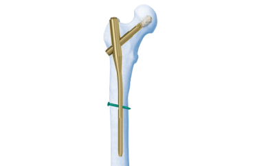 Ca hay tháng 12/2018: Mổ kết hợp xương gãy liên mấu chuyển xương đùi cho bệnh nhân 101 tuổi