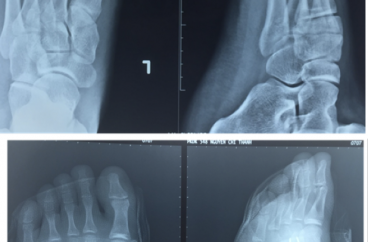 Kết quả điều trị gãy thân xương bàn chân 2,3,4,5 bằng kim 